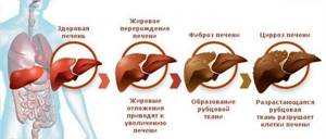 Как болит печень: симптомы у мужчин - основные признаки