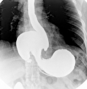 Рентген желудка с барием, что показывает рентгенография желудка
