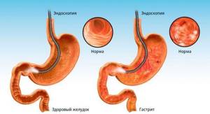 Глисты в желудке: симптомы, диагностика, лечение червей