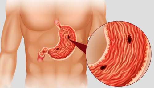 Открытая язва желудка: причины, симптомы и лечение