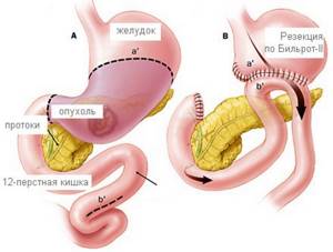 Растянутый желудок: признаки и что делать? Фото желудка