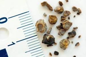 Причины появления камней в почках, от чего бывают камни