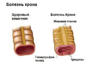 Причины и лечение боли в кишечнике слева внизу живота