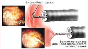 ФГДС и ФГС желудка с биопсией - подготовка и как делают