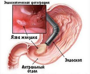 Эрозивный гастродуоденит: причины, симптомы и лечение