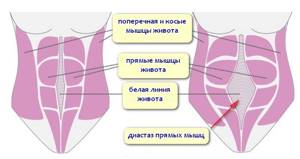 Признаки грыжи на животе у мужчин и женщин - симптомы брюшной грыжи