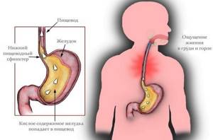 Желудочный кашель: симптомы и лечение народными средствами, медикаменты