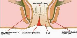 Воспаление ануса (заднего прохода): причины и лечение в домашних условиях