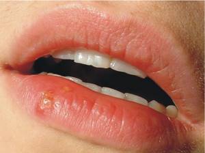 Воспаление слизистой рта: причины, симптомы и лечение