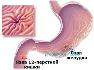 Профилактика язвенной болезни желудка и двенадцатиперстной кишки - лекарства