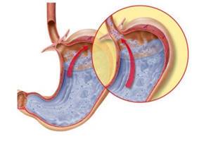 Недостаточность кардии желудка: причины, симптомы и лечение несмыкания