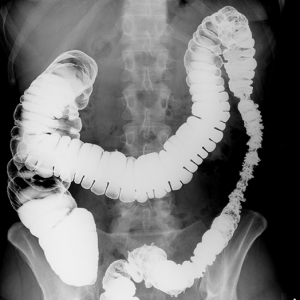 Рентген желудка с барием, что показывает рентгенография желудка