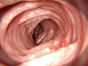 Причины появления полипов в кишечнике, симптомы и лечение