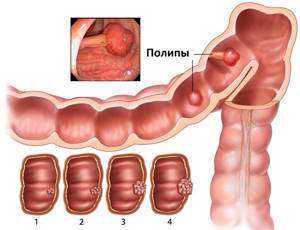 Полипы в кишечнике: основные симптомы заболевания у взрослых
