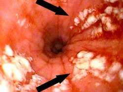 Грибок в кишечнике (кандидоз): симптомы и лечение инфекции