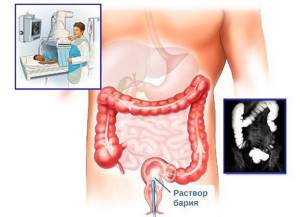 Что такое ирригоскопия кишечника: проведение процедуры, показания и противопоказания