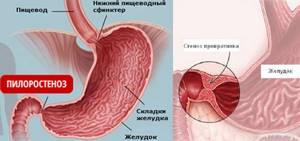 Стеноз привратника желудка - симптомы и лечение, что это такое