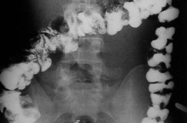 Рентген кишечника с барием - что показывает исследование