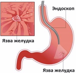 Причины и симптомы язвенной болезни желудка