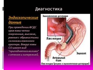 Перфоративная язва желудка и двенадцатиперстной кишки
