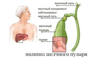 Лечение полипов в желчном пузыре, растворит и остановить рост полипа