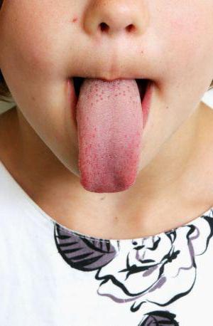 Желтый налет на языке у ребенка: причины и лечение